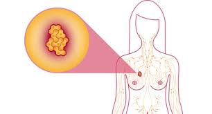 Nguy cơ ung thư vú tăng cao khi thụ tinh trong ống thử